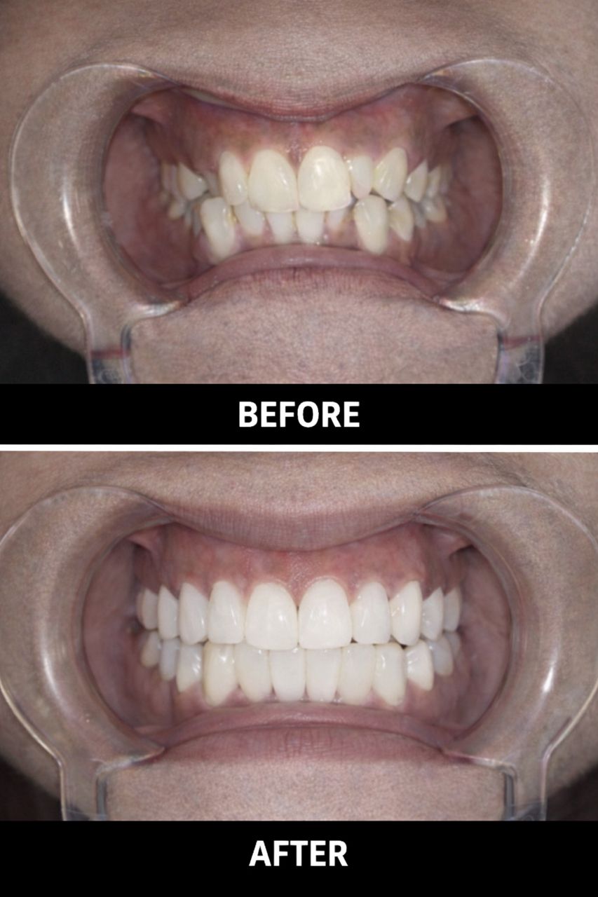 Correcting Crowded Teeth