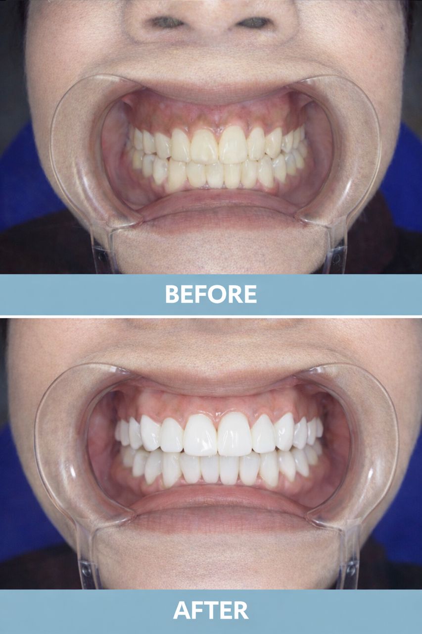 Full Smile Makeover